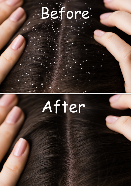 Anti Dandruff Serum